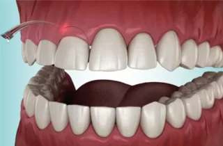 laser dentale cura gengive parodontite HOME 24